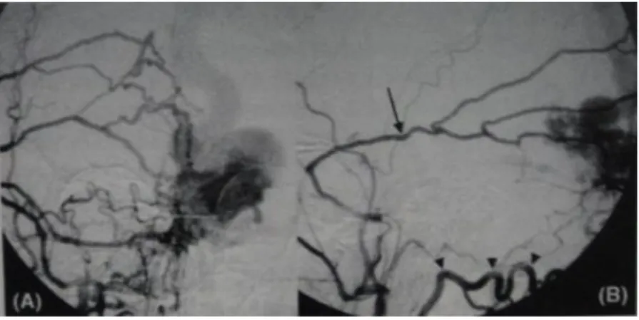 Gambar 19.  Karotis eksterna menyuplai AVM dari meningea media (panah,B) dan  cabang oksipital (kepala panah,B)