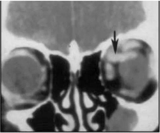 Gambar  3  :  CT  scan  potongan  coronal,  tampak  gambaran  vena  optalmikus  superior  kiri  yang  membesar  dan  berkelok-kelok  (panah)