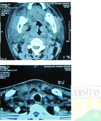 Gambar 2.Tomografi komputer parafaring potongan axial  Pada  tanggal  19  Februari,  pasien  semakin  sulit  bernafas  dan  bengkak  di  leher  bertambah  besar