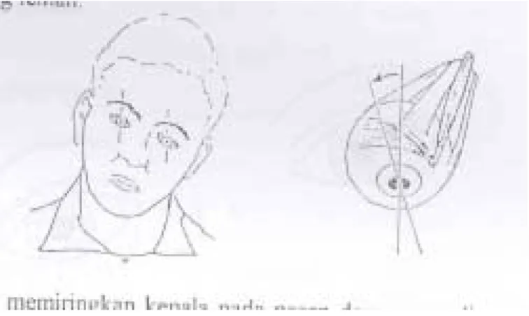 Gambar 5: Kompensasi memiringkan kepala pada pasen dengan paralise otot  oblikus superior mata kanan (dikutip dari John Patten) 