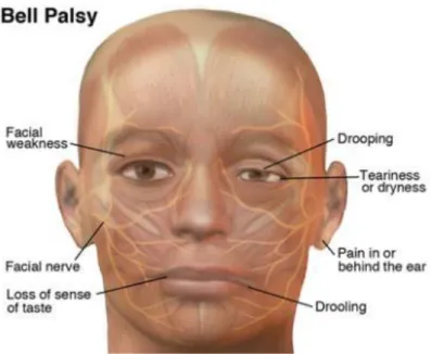Gambar 3.1. Gambaran Bell‟s Palsy (Dikutip dari http://www.moveforwardpt.com/)    Wajah menjadi asimetris karena sudut mulut dan sudut mata sebelah kanan turun  ke  bawah