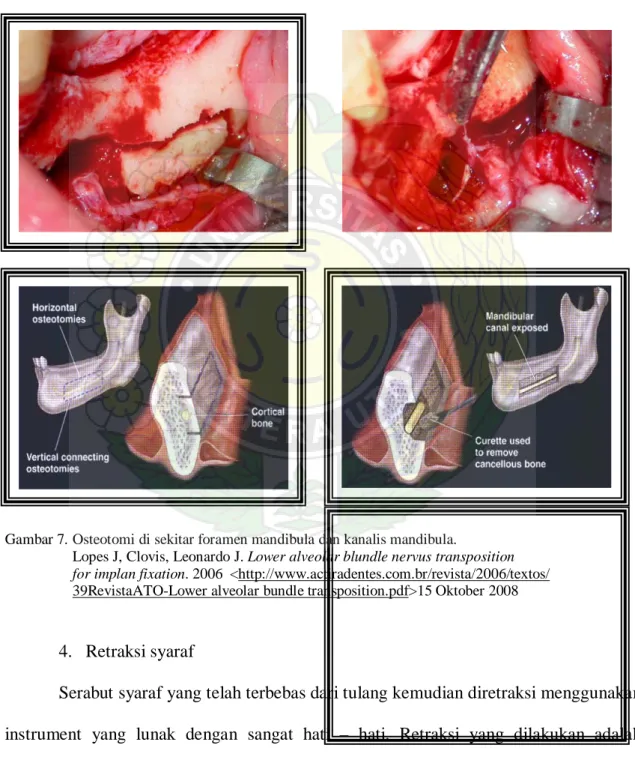 Gambar 7. Osteotomi di sekitar foramen mandibula dan kanalis mandibula.