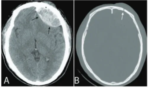 Foto  rontgen  kepala  tidak  memiliki  peran  yang signifikan dalam mendiagnosis kelainan  intrakranial