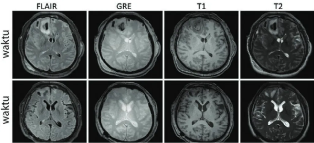 Gambar 11. Gambaran MRI pada cedera kepala akut dan kronis. 10