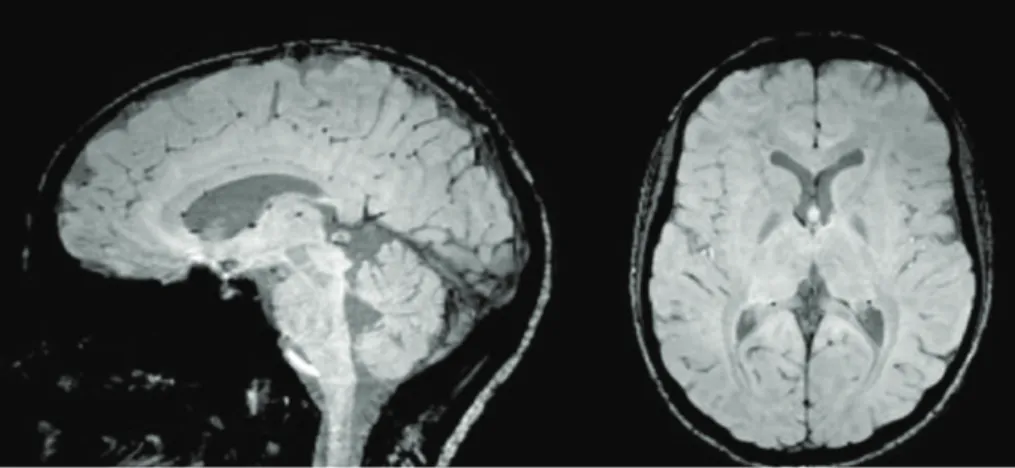 Gambar 12. Potongan sagital (kiri) dan aksial (kanan) dari SWI pada otak normal. Area titik hitam menunjukkan  pembuluh darah otak yang menyengat karena menggunakan SWI