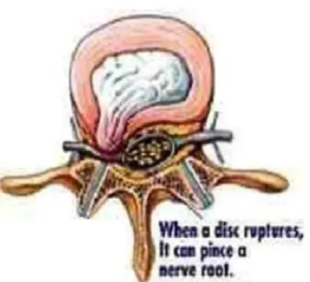 Gambar 4. “penonjolan” nucleus pulposus