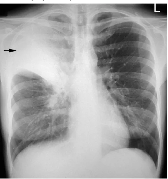 Gambar 2. Gambaran pneumonia lobaris lobus superior paru kanan 