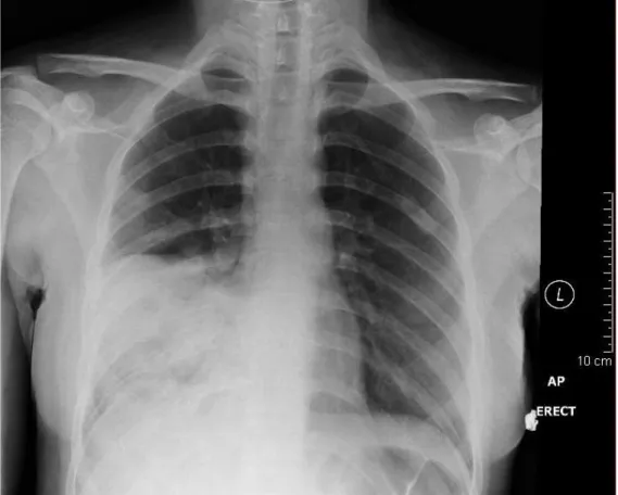 Gambar 3. Gambaran pneumonia lobaris lobus medius dan superior paru kanan 