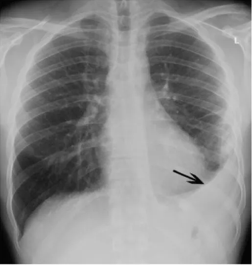 Gambar 6. Gambaran pneumonia lobaris lobus inferior paru kiri