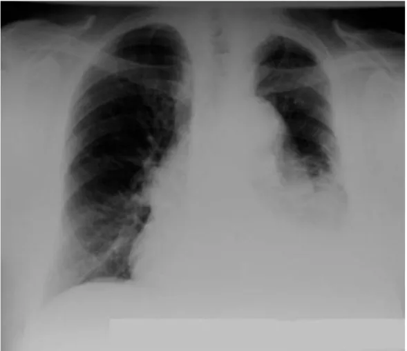 Gambar 8. Gambaran pneumonia lobaris lobus inferior paru kiri disertai penyulit efusi pleura kiri (pleuropneumonia paru kiri)