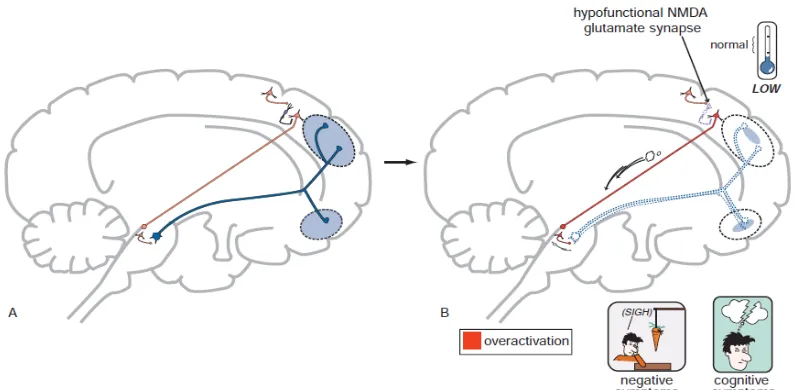 Gambar 6. Hipofungsi NMDA di hipokampus dan gejala positif pada skizofrenia  (Stahl, 2013)