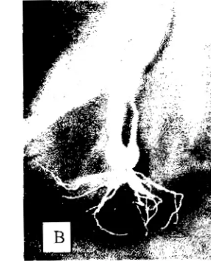 Gambar 1.  A  Tanaman bawang merah di  lahan menunjukkan gejala serangan  penyakit Iayu Fusarium