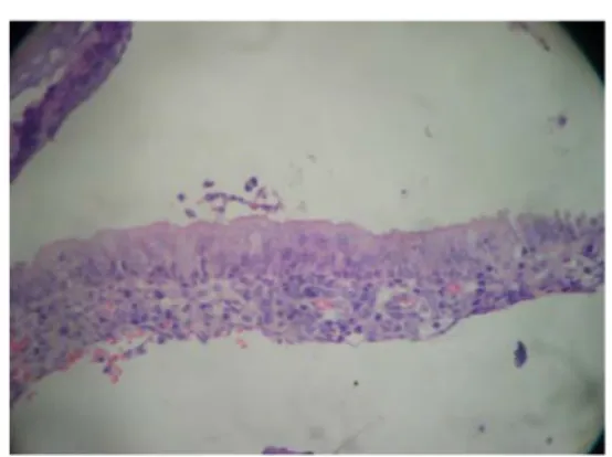 Gambar 11. Derajat kelainan histologi mukosa nasofaring (Sulistyo, 2008 ; Chan, 2005)  Displasia ringan adalah kelainan inti sel yang minimal lebih banyak terjadi pada  ketebalan epitel sepertiga basal dan sedikit di lapisan atas, yang mana menunjukkan mat