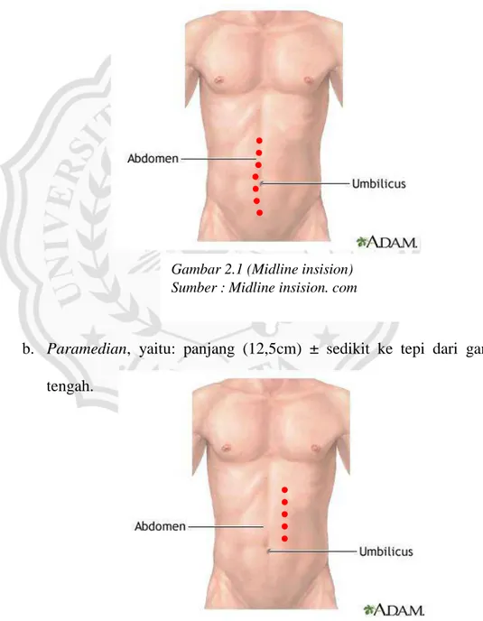 Gambar 2.1 (Midline insision)  Sumber : Midline insision. com 