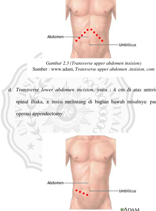 Gambar 2.3 (Transverse upper abdomen insision)  Sumber : www.adam, Transverse upper abdomen .insision