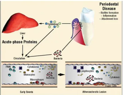 Gambar 2. Hubungan penyakit periodontal dengan aterosklerosis (Dave, et      al. 2004) 