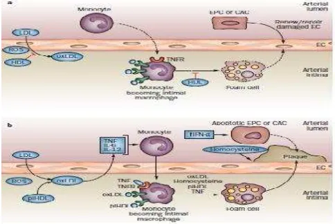 Gambar 2.1 Plak Aterosklerosis (Skaggs, 2012) (10)
