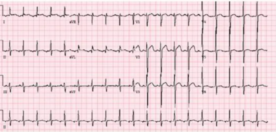 Gambar  3.  Gambaran  EKG  dengan  Takikardia  atrium.  Pada  Elektrokardiogram  menunjukkan  gambaran gelombang P yang berbeda dengan irama sinus (gelombang P yang negatif di sadapan  II)