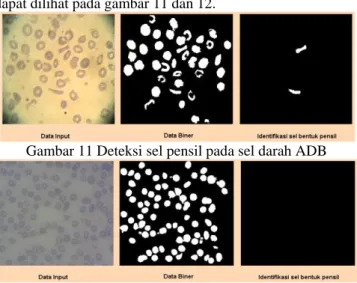 Gambar 11 Deteksi sel pensil pada sel darah ADB 