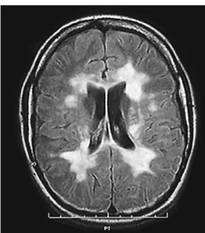 Gambar 2.2. MRI Otak Wanita 25 Tahun dengan Relapsing-Remitting MS