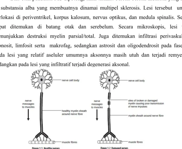 Gambar 2.1 Perbedaan Neuron yang Sehat dan yang Mengalami Demyelinisasi