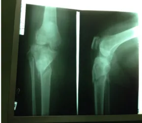 Gambar	2.	Gambaran	xray	regio	cruris	dextra.	 	