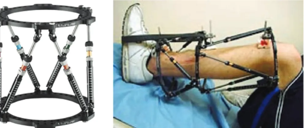 Gambar 6 Fiksasi internal dengan bahan dasar neodiniumGambar 5 Taylor Spatial Frame Fixator6