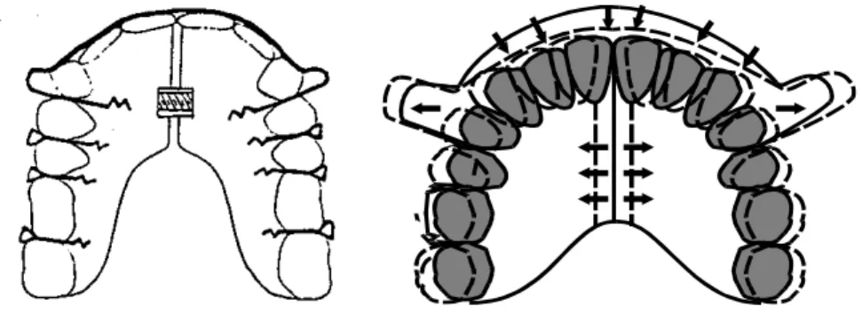 Gambar 6 :  Plat ekspansi lateral paralel, simetris (  Graber, 1084 )