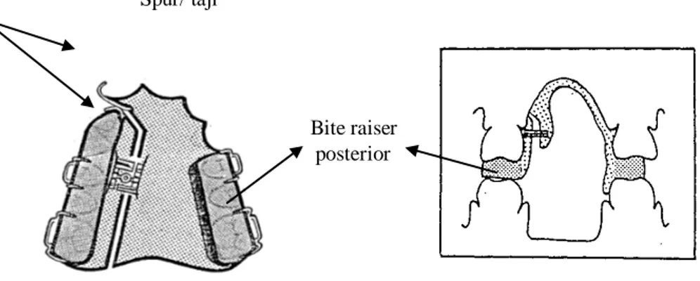 Gambar 7 :  Plat ekspansi arah lateral, paralel, asimetrisl (  Dickson, 1977 ) 