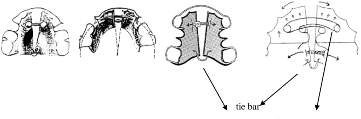 Gambar 8 : Plat ekspansi lateral non paralel, simetris