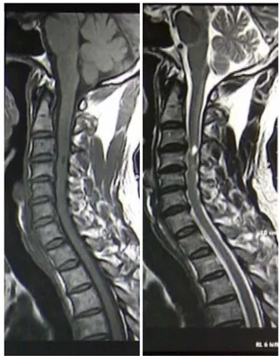 Gambar  1.  Gambar MRI potongan sagital  T1W (kiri) dan T2W (kanan) 