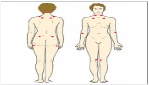 Gambar 4. Letak tender points di tubuh (20)  F. Diagnosis Fibromialgia 