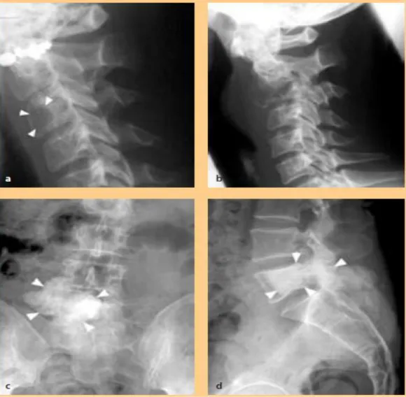 Gambar 6. Gambaran massa tulang pada X-ray (21)  G. Penatalaksanaan Neoplasma Vertebra 