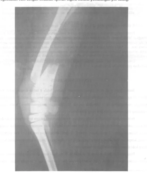 Gambar 1.  Foto sinar X yang diambil empat hari setelah kejadian patah tulang 