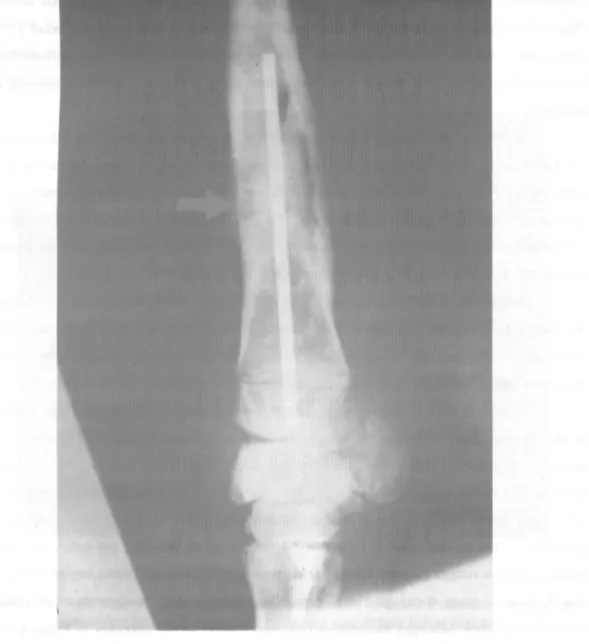 Gambar 2.  Foto sinar X yang diambil segera setelah operasi. Perhatikan posisi pin di dalam  persendian carpus 