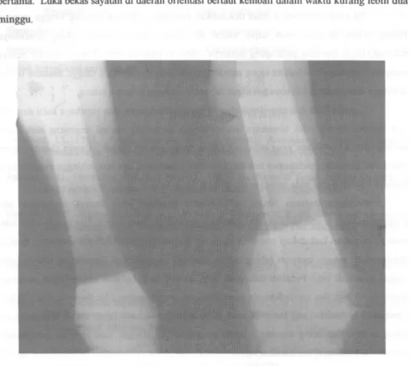 Gambar  3.  Foto  sinar  X  yang  diambil  memasuki  bulan  ke-enam.  Perhatikan  pembesaran  persendian karpus dan ujung pin proksimal yang bebasa keluar dari rongga tulang 