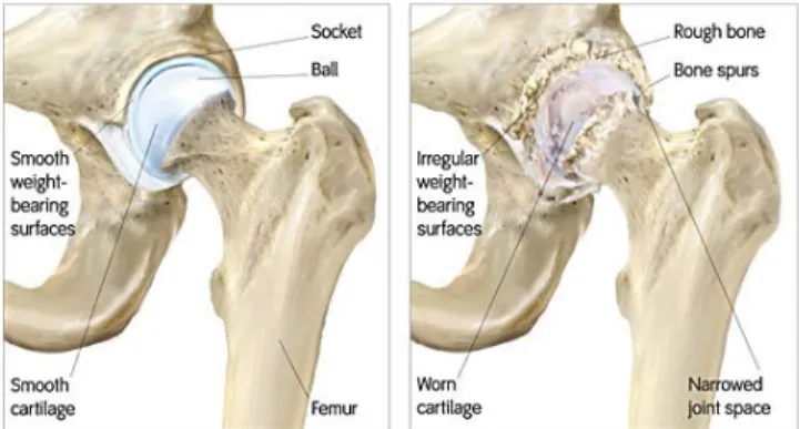 Gambar 2.3. Perbandingan hip joint a. pada keadaan normal b. Hip arthritis [8].