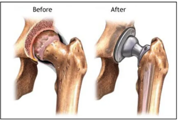 Gambar 2.5. Hip joint sebelum dan sesudah dilakukan hip joint replacement [33].