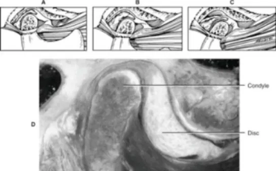 Gambar  1  Dislokasi  diskus  ke  anterior  tanpa  reduksi.  A.  Posisi  sendi  tertutup  sewaktu  istirahat