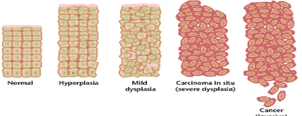 Gambar 2.  Perkembangan sel normal menjadi sel kanker (Anand and  Kunnumakkara, 2008)