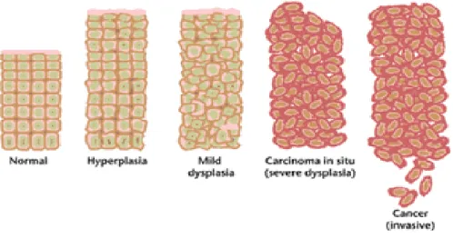 Gambar 2. Perkembangan sel normal menjadi sel kanker (Anand and   Kunnumakkara, 2008).
