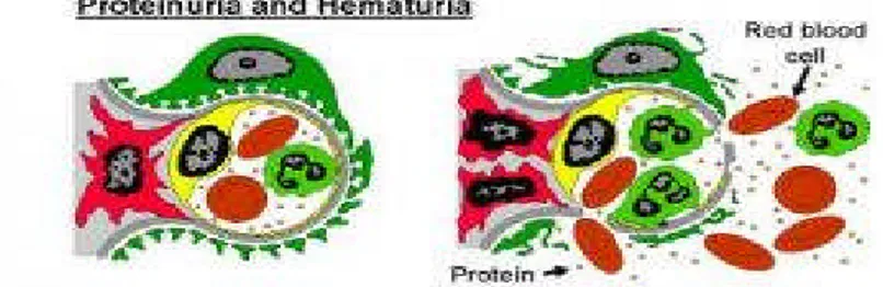 Gambar 4. Proses terjadinya proteinuria dan hematuria