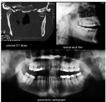 Gambar 2.5 Gambar radiograf fraktur mandibula  (http://emedicine.medscape.com/article/868517-treatment)