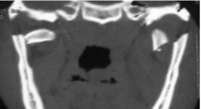 Gambar 2.6 CT Scan koronal menunjukkan fraktur bilateral condylar (http://emedicine.medscape.com/article/868517-treatment) 