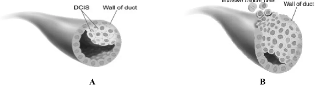 Gambar 1.12 Ductal Carcinoma in situ (A) dan Sel-sel kanker menyebar keluar dari  ductus, menginvasi jaringan sekitar dalam mammae (B)