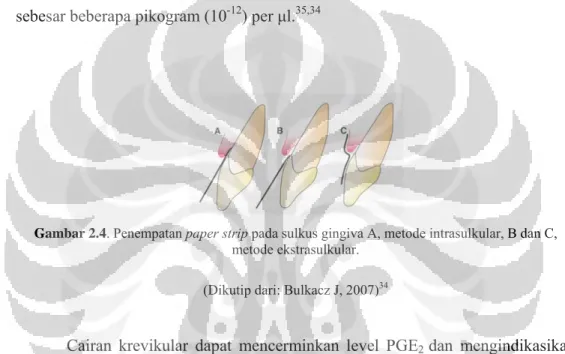 Gambar 2.4. Penempatan paper strip pada sulkus gingiva A, metode intrasulkular, B dan C,  metode ekstrasulkular