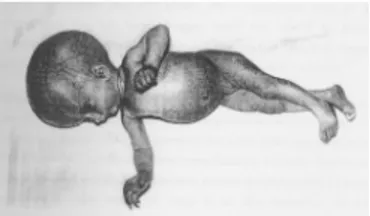Gambar 4.  Seorang bayi yang dilahirkan dengan  gejala hidrosefalus 