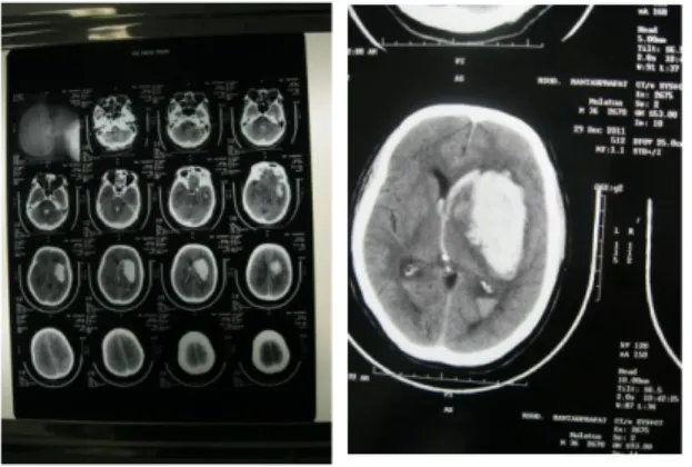 Gambar : CT Scan  Diagnosa: 