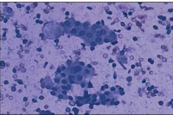 Gambar  9.  Tiroiditis limpocitik. Dua kelompok dari sel folikuler jinak tampak  pada latar belakang limposit ( Mestman JH et.al, 2013 )