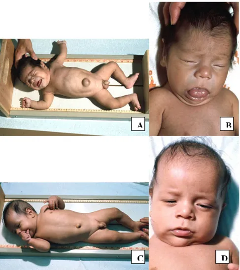 Gambar 2. A dan B. Bayi dengan hipotiroidisme kongenital, ikterus, lidah besar, wajah  sembab, serta letargi